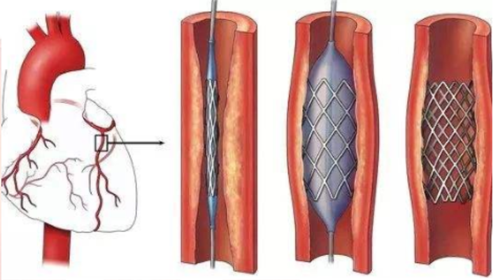 冠心病高发经皮冠状动脉介入治疗pci来救命
