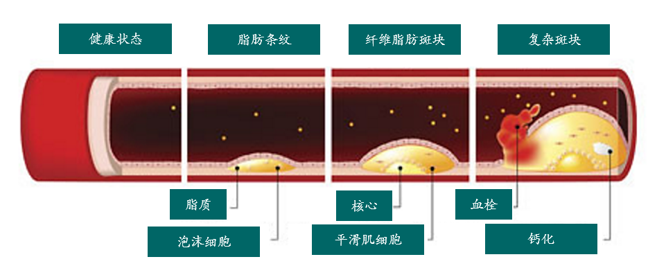 动脉粥样硬化阶段示意图