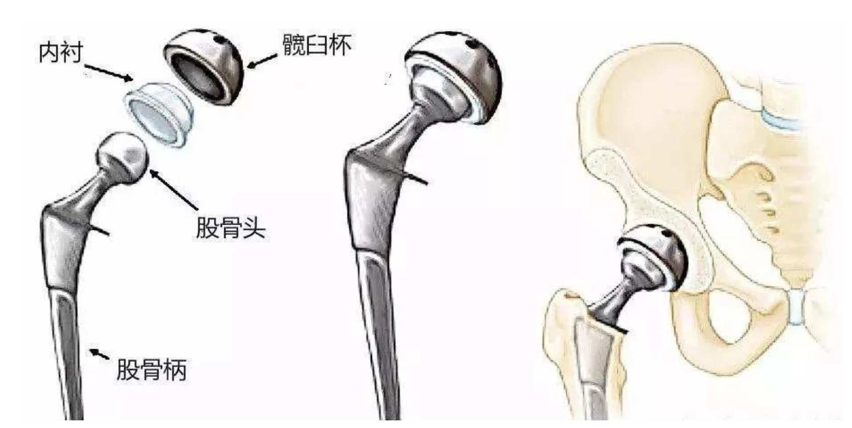 髖關節置換手術系統概念圖