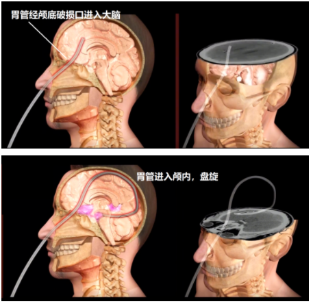 浙大二院胃管「插入脑」？医学上永远都有你想不到的发生