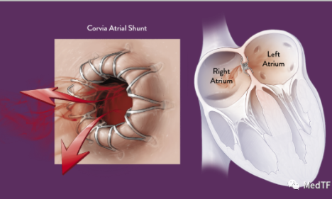 IASD：Corvia Medical开启新的临床研究